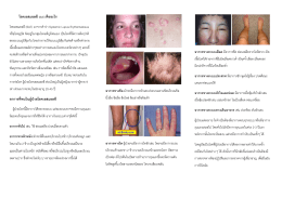 โรคเอสแอลอี(SLE) - โรงพยาบาลสถาบันโรคไตภูมิราชนครินทร์