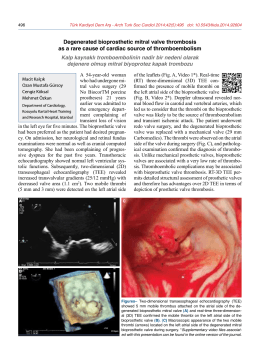 Degenerated bioprosthetic mitral valve thrombosis as a rare cause