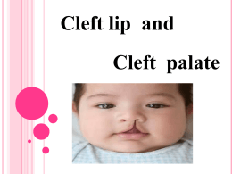 Cleft lip and cleft palate