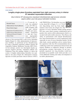 Lengthy single piece thrombus aspirated from right
